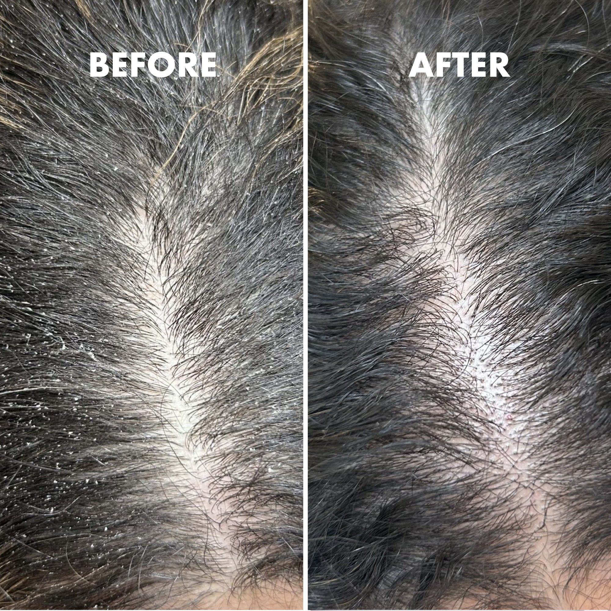 Restore Dry Itchy Scalps Treatment Kit